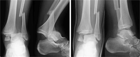 right ankle fracture icd 10|right ankle surgery icd 10.